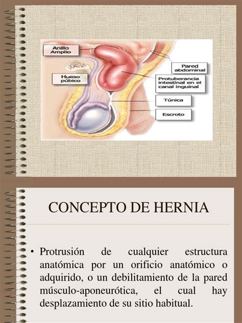 hernia inguinal infantil pdf